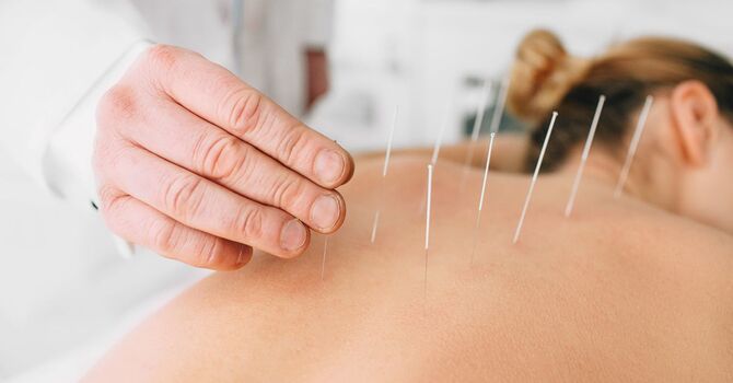 Can Acupuncture Help With Sports Injuries? image